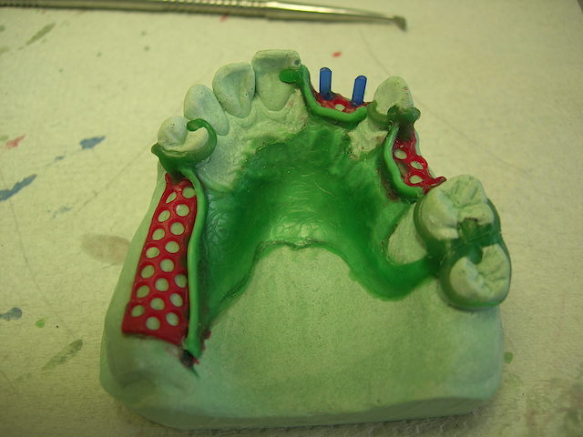 Modellation einer parodontienfreien Hufeisenplatte