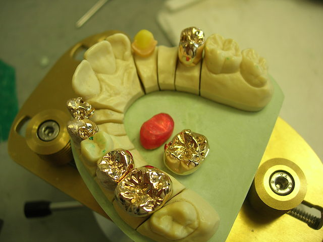 Teilungsgeschiebe mesial an Zahn 25. Sekundärkronen an Zahn 15 und 16